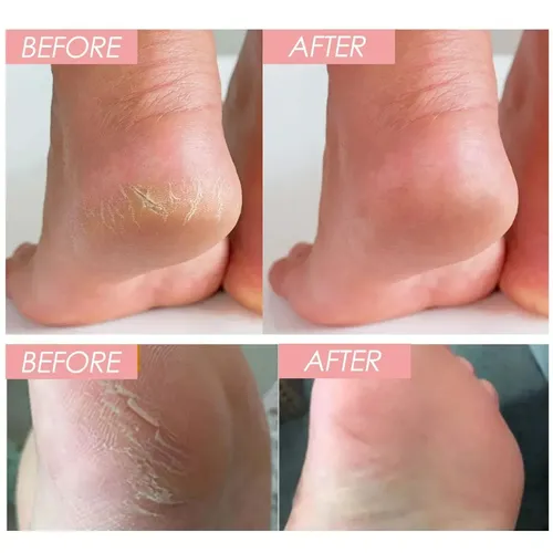 Crema Hidratante Gel Exfoliante Para Pies Y Manos Fd