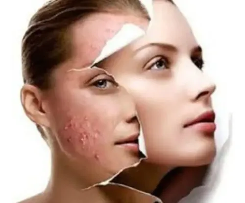 Carthage Emulsion Hidratante Pieles Grasas Acne Poros