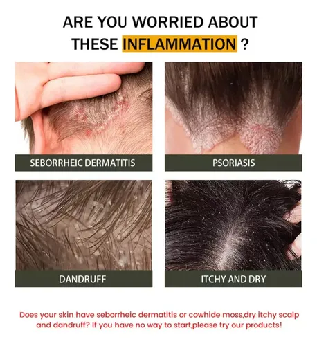 2 Piezas De Crema For La Dermatitis Seborreica .
