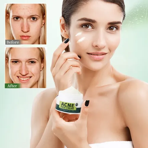 Crema Antiacné Para Reducir Las Marcas Del Acné