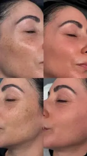 Cr Blanqueadora Para Pecas Mancha De Sol Acne Edad Hidroq 4%