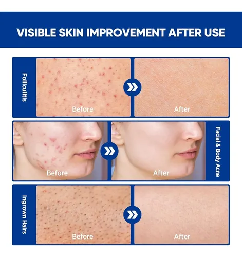 Crema Antifoliculitis Y Acné Aosorw 100 G