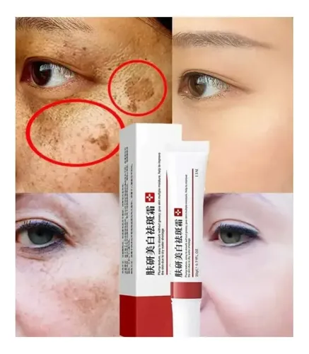 Crema Eliminadora De Melasma No Rosto Melanina Acne Clareado