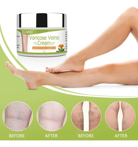 Improves Blood Circulation, Reduces Spider Veins And