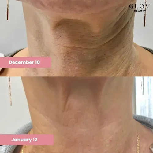 Crema Cuello Lifting Glov Beauty 6.1\x201d X 1.46\x201d