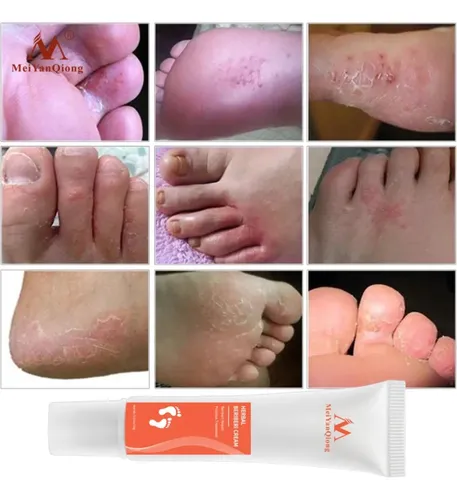 Crema Suero Antiinfección Pies Efectiva Hongos Onicomicosis