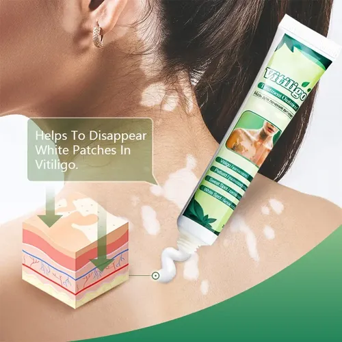 Y 4crema For Vitíligo Crema For Quitar Las Manchas Y