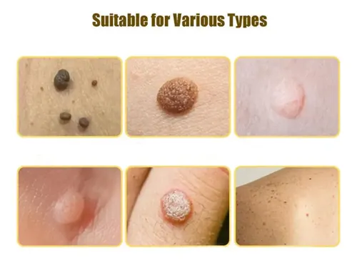 Crema Antipigmentaria Para Eliminar Las Verrugas Del Herpes,