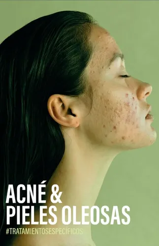 Sebum Treatment Tratamiento Acne Con Salicilico Idraet Full