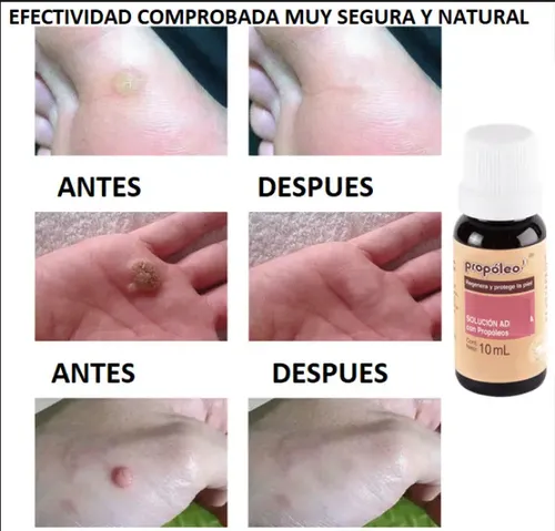 Crema para Eliminar Verrugas del Cuerpo con Propóleo y Fórmula Natural de 10 mL