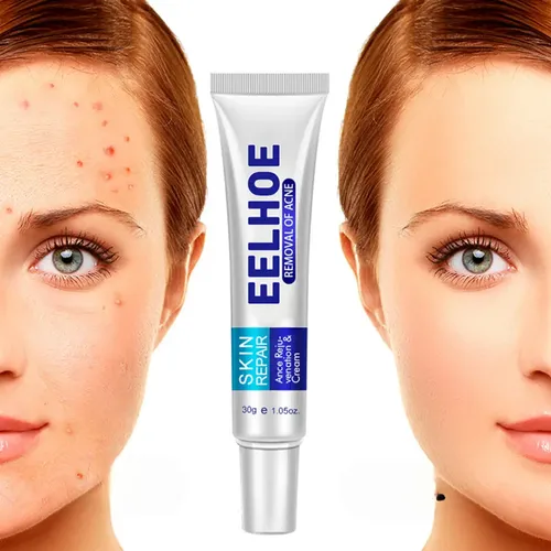 Crema Para El Acné Eelhoe: Disminuye Las Imperfecciones Y Eq