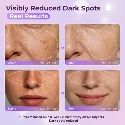 Lguyo Eliminar Manchas De Edad Rostro Y Cuerpo 1.7 Oz