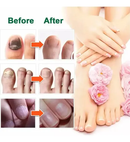 Suero Reparacion Uñas Ataca Hongos Onicomicosis 100% Calidad