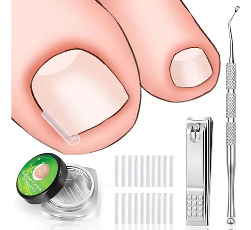 Mokasi Kit De Eliminación De Uñas Encarnadas, 50 Pcs