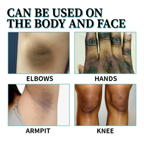 La Crema Reutilizable Para Dermatomas Con Puntos Negros Ouho