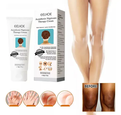 Hd Fixderma Nigrifix Crema Para Acantosis Nigricans Fbg,h