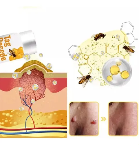 Zspray Para Verrugas Con Veneno De Abeja Para Reparar La Pie