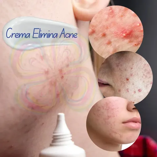 Paquete 3 Cremas Bioaqua Puntos Negros Anti Acne