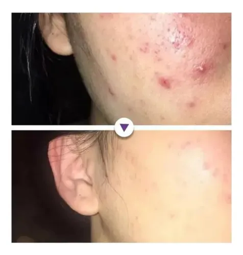 Crema Calmante Anti-acné: Ideal For Piel Sensible ^.^