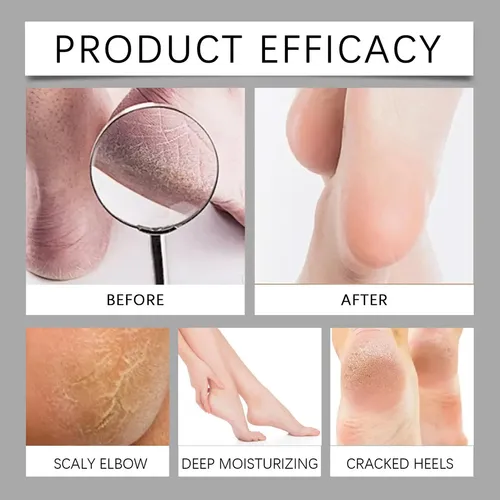 Creme Esfoliante Para Cuidados Com Os Pés Com Uréia 100g 1pc
