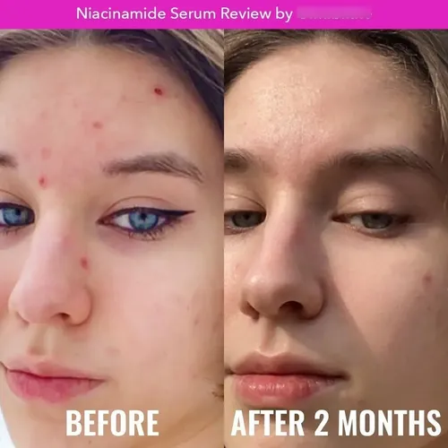 Serum Good Molecules Niacinamide – 30 Ml Para Piel Grasa