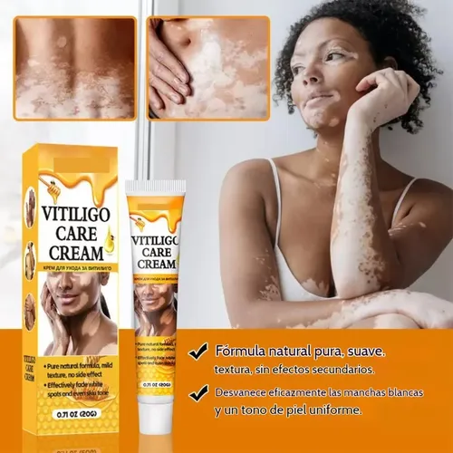 Crema Reparadora De Manchas Blancas Para El Vitíligo *3h