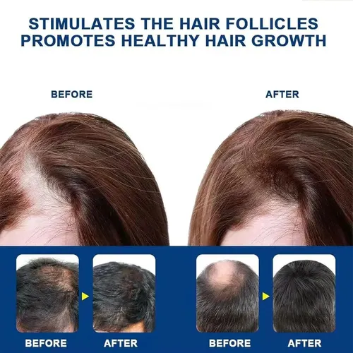 . Crema De Masaje Con 5% De Minoxidil For El Crecimiento *
