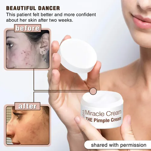 Crema Milagrosa Anna Guanche Md  Tratamiento De Acné