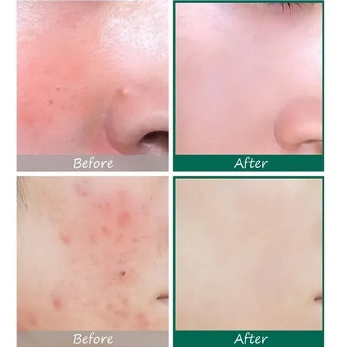 Crema Hidratante Antiacné Aaw 30 Días Miracle W, Ss