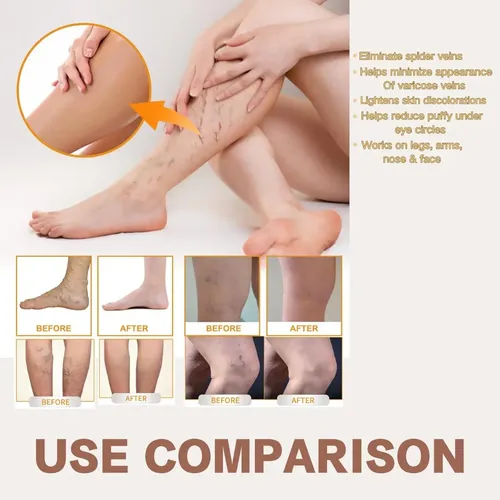 2 Unidades De Crema Milagrosa For Varices Con Vitamina K