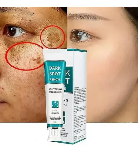 Láser Eliminador Cicatrices + Crema Blanqueadora Efectiva Todo Tipo De Piel Día/noche