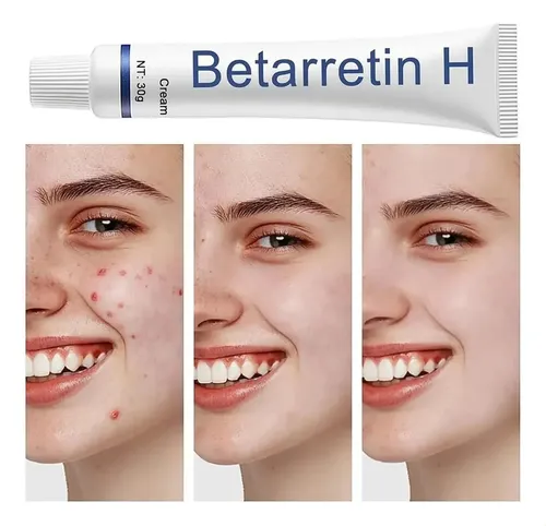 Creme Clareador, Creme De Hidroclorotiazida De Betametasona.