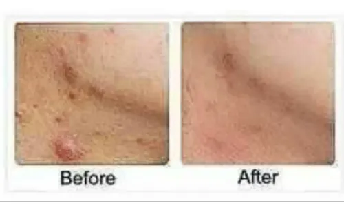 Ácido Salicilico,crema,serum O Solución.acne Y Piel Seborrei