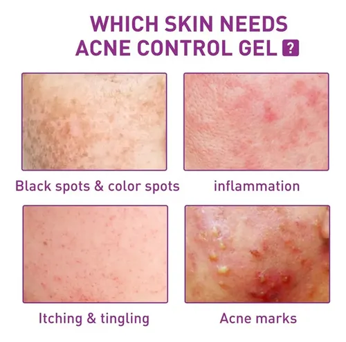 3 Unidades Crema Azelaica Un 10% Ácido Azelaico, C Acneica