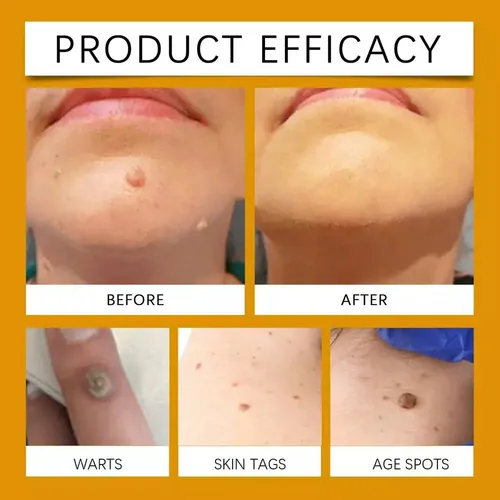 -=crema For Tratar Verrugas Y Lunares Con .=-