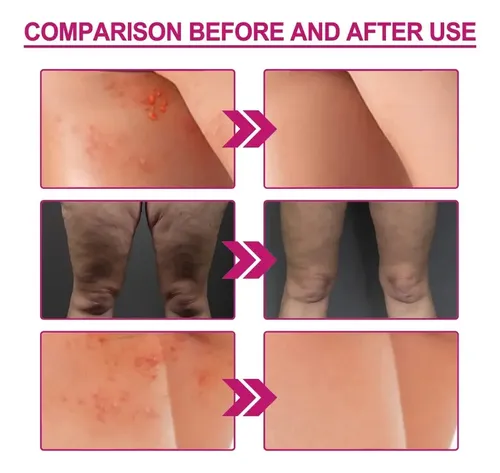 Crema For El Acné, Limpieza De Manchas Oscuras, Espinillas –
