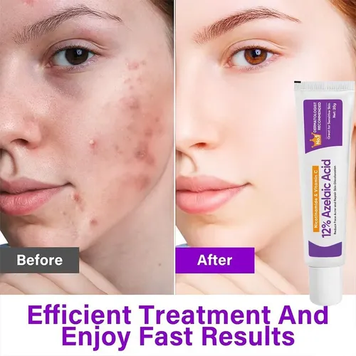 Crema Facial Con Ácido Azelaico 12% 20 G Para Acné Todo