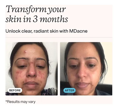 Crema Tratante Para Acné Mdacne Ácido Salicílico 2.0% 15 Ml