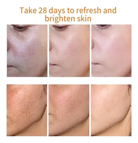 Crema Para Eliminar Pecas Y Melasma Para Manchas Oscuras Ym