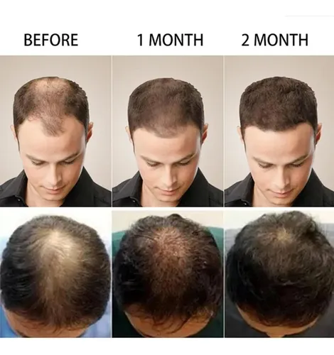 . Crema De Masaje Con 5% De Minoxidil For El Crecimiento *