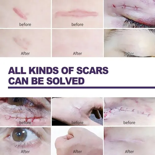 Láminas Indoloras Con Cinta Adhesiva De Silicona Para Repara