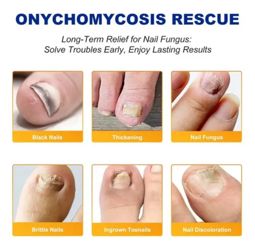 +parches Para Hongos En Las Uñas De Los Pies (3 Piezas).