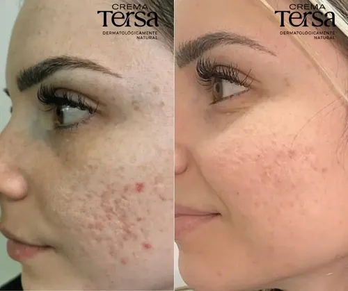 Mzcrema Tersa Despigmentante Quita Manchas Acné Paño De 40gm