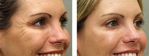 Gel Facial Hidratante Ácido Hialurónico 5% 250ml Anira