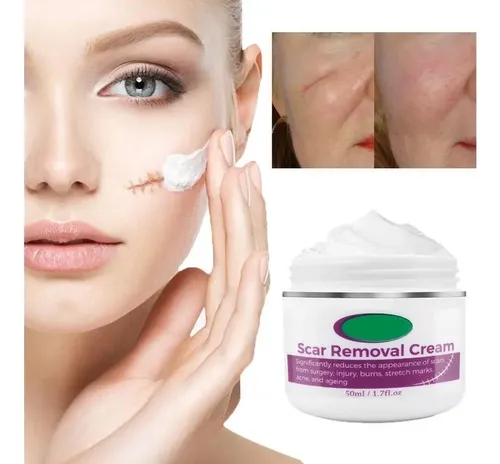 Crema For Eliminar Cicatrices Y Estrías, Alivio Y Quemaduras