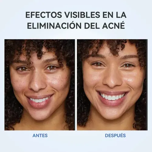 Aatónico De Ácido Salicílico Con Aceite Y Control De Porosss