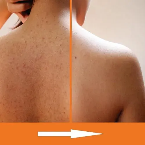 Kerapil Jabon Corporal Exfoliante Acido Salicilico