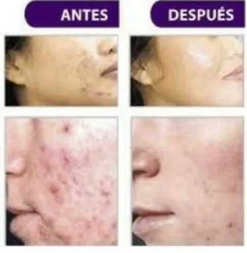 Ácido Salicilico,crema,serum O Solución.acne Y Piel Seborrei