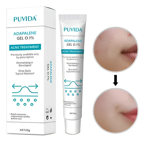Creme Para Acne Trata A Acne No Rosto E No Corpo