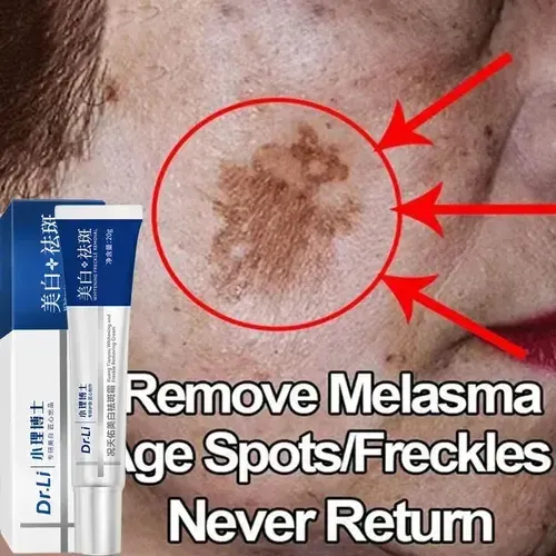 Crema Blanqueadora De Melasma Para Una Eliminación Eficaz